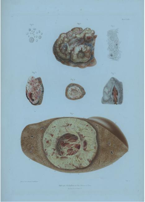 Fig. 1 (The physiologie pathologique-1845) Kanserli karaciğer