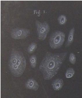 Fig.3 the Traite d anatomie pathologique- 1857) Rektum kanseri olan