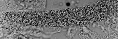 hircicanis mikrokisti. HE x 200. Şekil 6. Özefagus.Yangı hücreleri ile infiltre olmuş dejenere Sarcocystis mikrokisti. HEx 200.