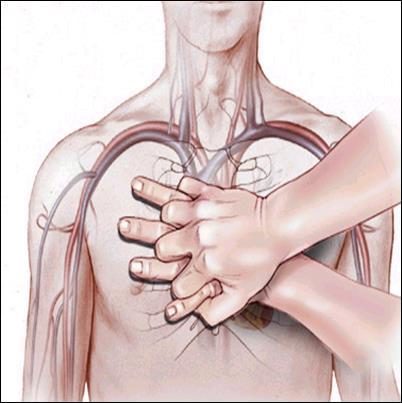 5 Kardiak arrest sebebi olabilecek durumlar: - Kalp bölgesi üzerine şiddetli travma - Çeşitli kalp hastalıkları - Aşırı sıvı kaybı - Hipoksi ( O 2 azlığı ) - Elektrik çarpması - Suda boğulma - Bazı