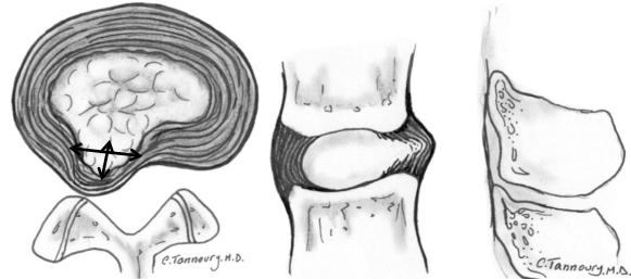 Protrüde disk