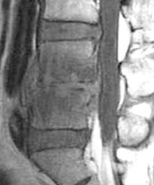 VERTEBRAL KEMİK İLİĞİ;MODİC