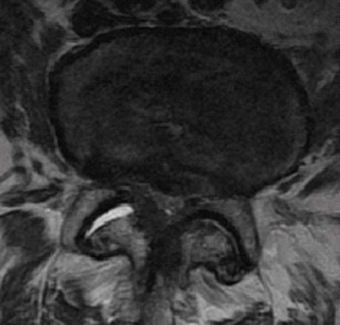 Foraminal stenoz