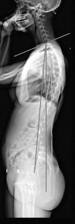 iii. Proksimal torakal tilt (PTT). Görülebilen en proksimal torakal vertebra üst uç plağı orta noktası ile bikokso-femoral noktayı birleştiren hattın vertikal hat ile olan açısıdır.