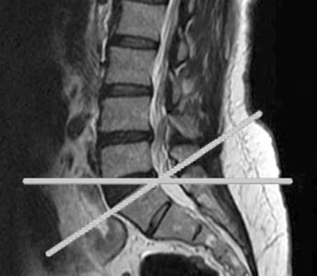 Spinal dizilim bozukluğu ile kuvvetli körele olduğu bildirilmiştir (2). iv. Sakral eğim (SS).