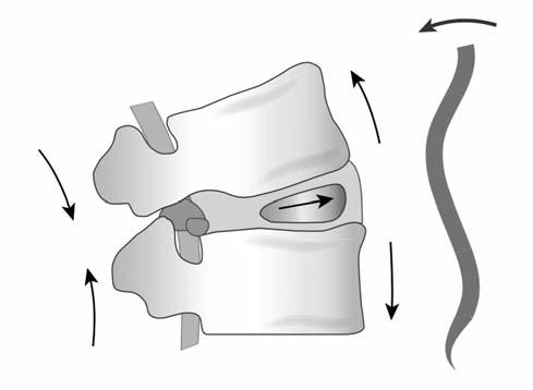 İntervertebral diskin anteriorunda basınç artışı olur nükleus pulposus posterior doğru yer değiştirir, Ligamentum flavum interspinöz ve supraspinöz