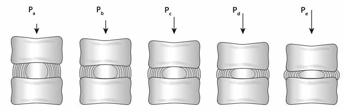 Normal erişkin bir insanda 23 adet intervertebral disk vardır. Toplam hacim olarak bakıldığında tüm spinal kolonun yaklaşık % 25 ini intervertebral diskler oluşturur (22).