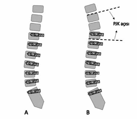 TANIM VE RADYOLOJİK BULGULAR PJK sıklıkla en üstteki enstrümante edilen vertabranın (upper instrumented vertebrae (UIV)) bir üstünde görülmektedir.