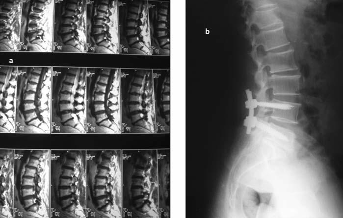 Bayerl ve arkadaşları, semptomatik dejeneratif spinal dar kanal olgularının, majör instabilite olmamak şartıyla sagittal spinal dengeden bağımsız olarak mikrocerrahi yöntemle yapılan dekompresyondan