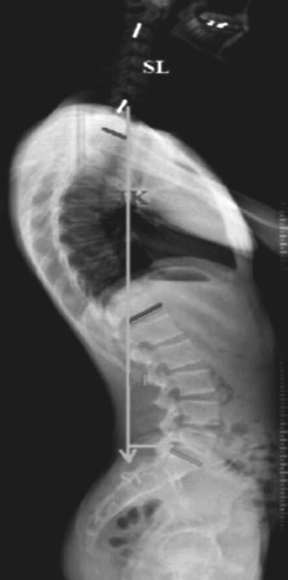 Spinal deformitelerde omurga ve pelvis arasındaki uyumu sağlamak için sagittal spinal ve spinopelvik parametreleri ve aralarındaki ilişkileri bilmemiz gerekir.