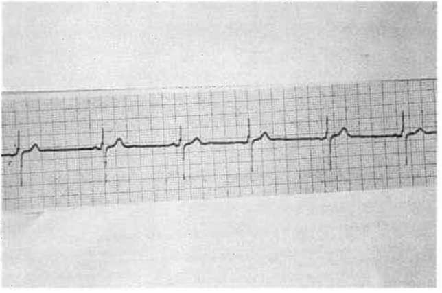 Yüzey EKG'dc morfolojisi ve ortalama vektörü, sinüs P dalgasından farklı olan prematüre P dalgaları ile tanınırlar (Şekil 3).