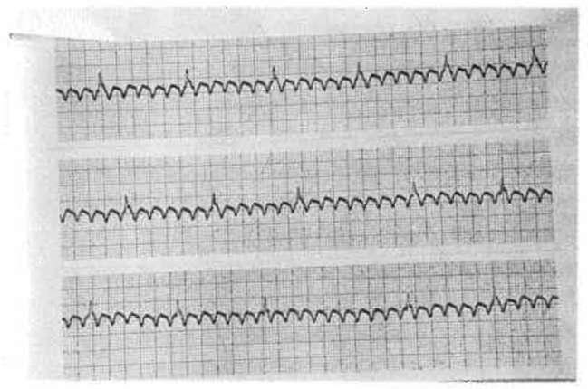 EKG de düzenli, normal QRS morfolojisi ile birlikte yaşa göre değişmekle birlikte 180-320/dk arasında bir hız gösteren taşikardi vardır (Şekil 8). QRS süresi 0.