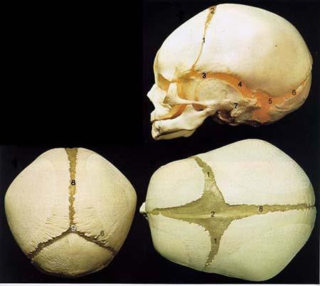 Fetal Skull 1. Future Coronal Suture 2. Anterior Fontanel 3. Anterolateral Fontanel 4. Future Squamosal Suture 5.