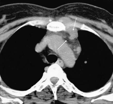 Orta mediastinal patolojiler: Metastatik