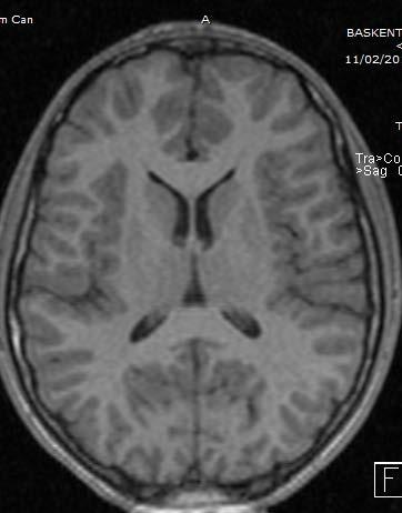 Tersine Dönme 1 ay T1A Adult T1A Yenidoğan beyni erişkinin tersidir YD beyninde su