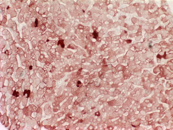 Resim 3: Hepatit B de bazı hepatositlerin sitoplazmasında buzlu