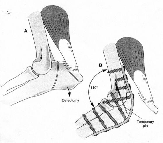52 kaudolateral yaklaşım ile ulaşılır ve olecranon un osteotomisi gerçekleştirilir (Şekil 1.23.). Eklem kıkırdağı tamamen uzaklaştırılır.