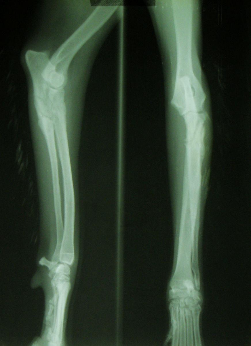 12 de radius da diyafizer segmental kırık, ulna da ise diyafizer transversal parçalı kırık şekillenmiş olup, açık redüksiyon ile kırık stabilizasyonları