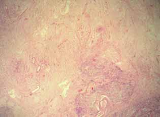 Schwannoma larda farkli morfolojik ve immune