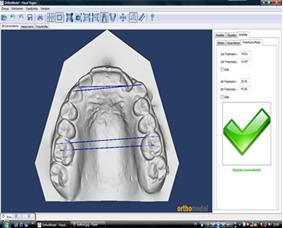 EÜ Dişhek Fak Derg 2011; 32: 103-108 edilme kriterleri 3. molarlar hariç tam bir dentisyon, tedavi öncesi sefalogram ile maksiller ve mandibular alçı modellerin bulunmasıdır.