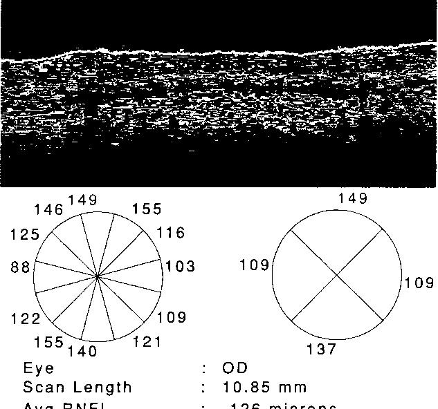 Retina sinir lifi kalınlığı normal sınırlar içinde bulunan bir hastaya ait OKT Daha sonra sinyal/gürültü oranıyla sinir lifi kalınlığının arasında bir ilişki olup olmadığının belirlenmesi için tüm
