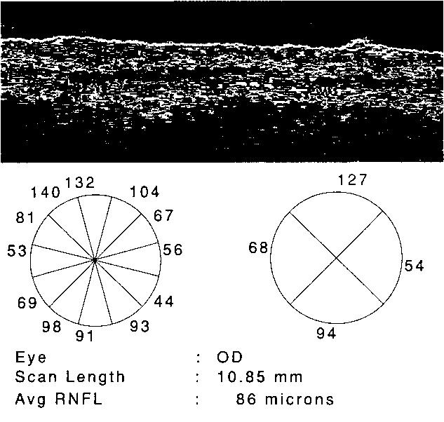 Erken Glokom ve Glokom Şüphesi Olgularında Optik Koherens Tomografi ile Elde Edilen Retina 407 Şekil 3.