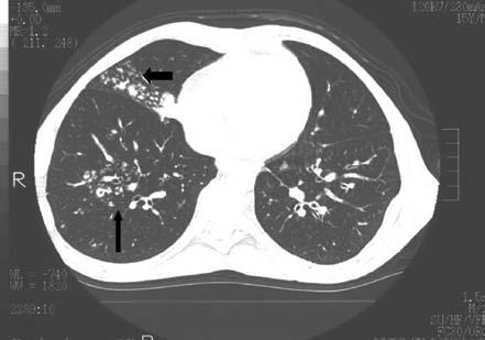 Tüberkülozun bronşial yayılımına bağlı olarak gelişen 1-10 mm çaplarında kötü sınırlı, salkım benzeri görüntü (tomurcuklanmış ağaç görünümü) oluşturan nodüller 3 hastada (%4)
