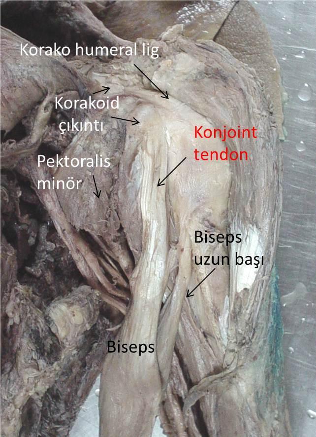 Şekil 7: Konjoint tendon, pektoralis minör ve korakoid çıkıntı orta tabakada izlenmekte.