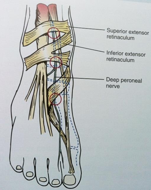 Anterior Tarsal Tünel Sendromu Derin peroneal sinirin ekstensör retinakulum altında tuzaklanması Semptomlar Ayak 1.2.