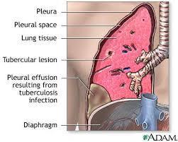 PLEVRAL EFÜZYON Pnömoni (zatürre), akciğer veremi, kalp yetmezliğinin ve kalp zarı iltihabının bazı tipleri, bazı böbrek ve