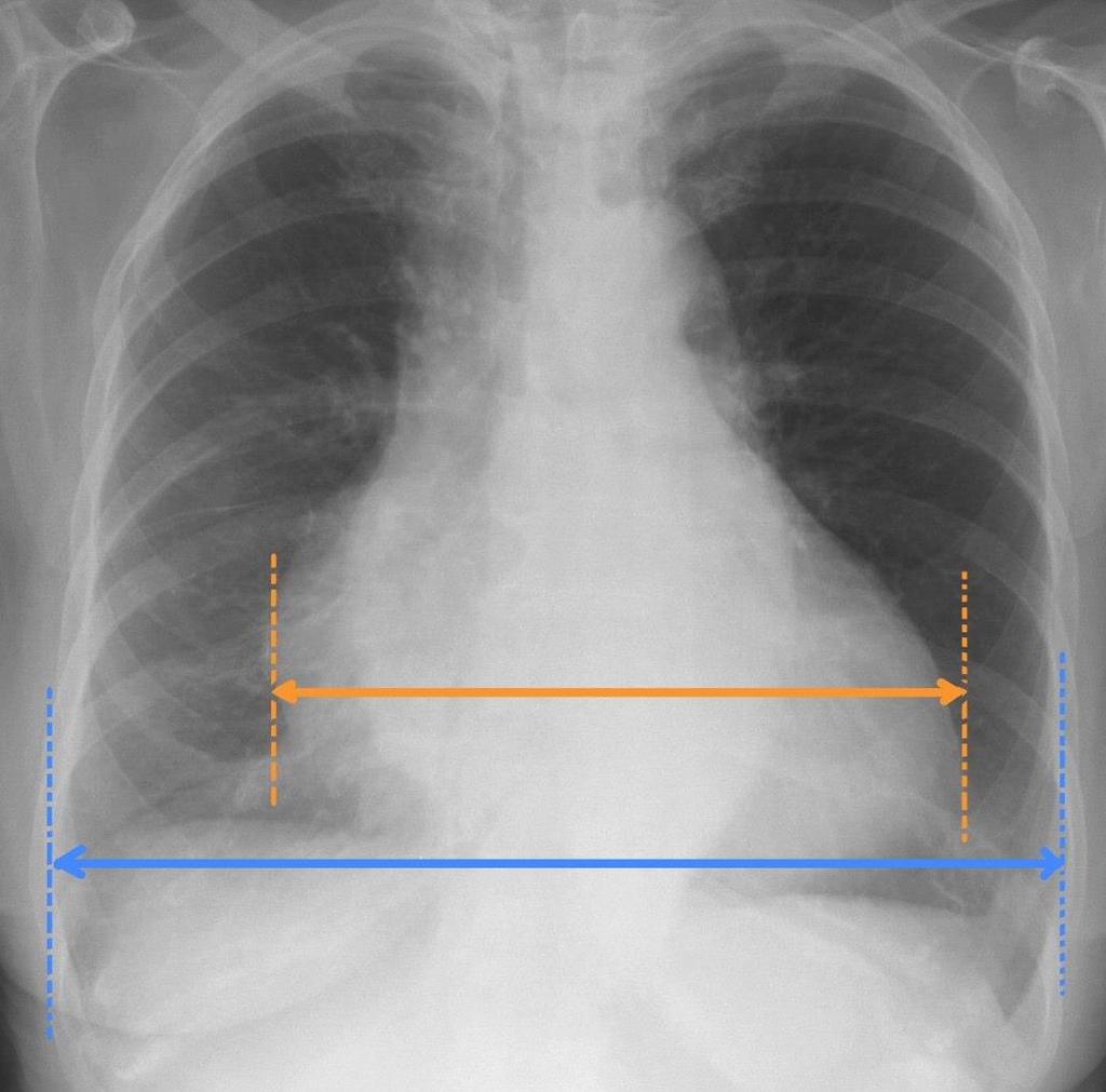 Kardiotorasik indeks Cardiomegali veya daha geniş anlamıyla kardiak siluetin genişlemesinin saptanmasında