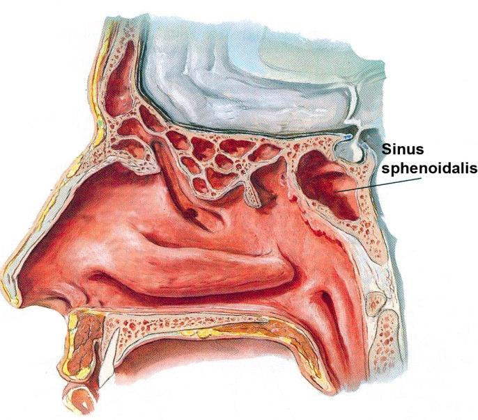 Şekil 1.25. Sinus sphenoidalis (Putz ve Pabst 2001). A. carotis interna, sinusun midlateral duvarı ile komşu iken, n. trigeminus (NT) inferolateral duvar ile, n.