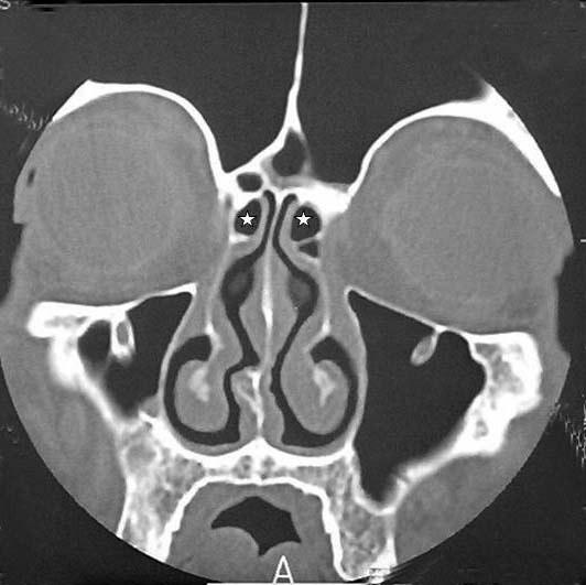 1.2.8.2. Bulla ethmoidalis Cellulae ethmoidalis anteriores in en büyük hücresine BE denir. BE, bulla lamellanın havalanması sonucu ortaya çıkar.