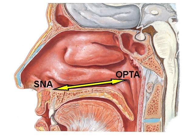 Şekil 2.5. 22 haftalık dişi fetus un sağ concha nasalis inferior (CNI), media (CNM), superior (CNS) ve suprema (CNSP) ön-arka uzunlukları.