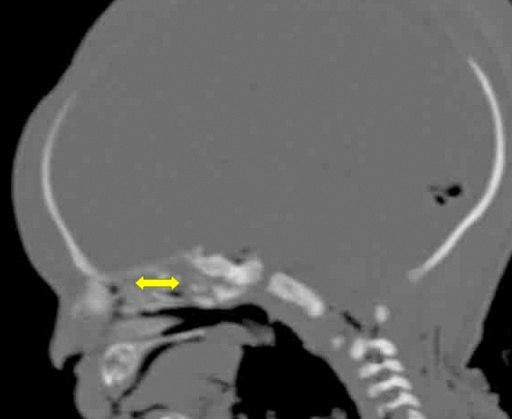 Concha nasalis superior uzunluğu (CNS): Concha nasalis superior ön-arka uzunluğu (Şekil 2.19). Şekil 2.19. Sagittal görüntülerde concha nasalis superior uzunluğu.