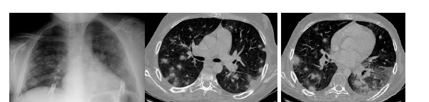 İnvazif Pulmoner Aspergilloz Akciğer grafisinde bilateral yama infiltrasyon