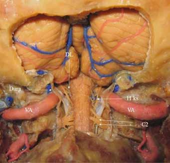 Anterior medüller segment preolivar sulkustan başlayıp hipoglossal sinirin kökçükleri önünden veya arasından geçer ve pontomedüller sulkusta veya yakınında karşı VA ile birleşmek üzere piramisi