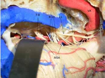Posterior serebral arter anatomisi Posterior serebral arter BA in terminalinden köken alır (Şekil 3, 4A, B ve 6).