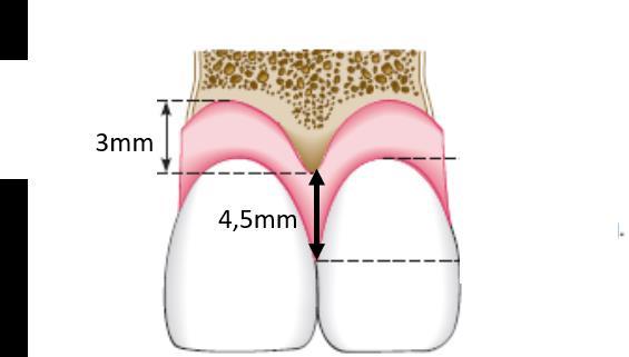 Yine yumuşak doku skallobu 4,5mm iken sert doku skallobu ortalama 3mm olmalıdır. Uygulanan restorasyon gövdesinin kretle uyumu da önemlidir. Bu konuda farklı dizayn seçenekleri mevcuttur. A.