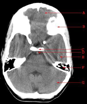 A. Frontal Lob B. Frontal kemik (orbita süperior yüz) C.