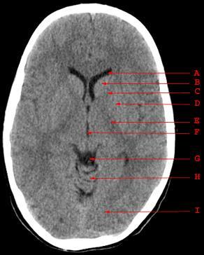 A. Lateral ventrikül anterior horn B. Kaudat nükleus C. Anterior kapsula interna D.