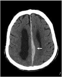 geçmez Subdural aralıktan geçen