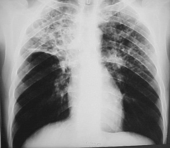 Akciğerler ; % 70-80 Diğer Organlar ; % 30-20