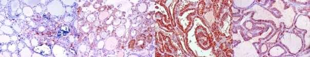 89 Galektin-3: Galektin-3 ile normal tiroid epitel hücreleri ve tümör hücrelerinde nükleer ve sitoplazmik boyanma izlendi (Resim 3). III).