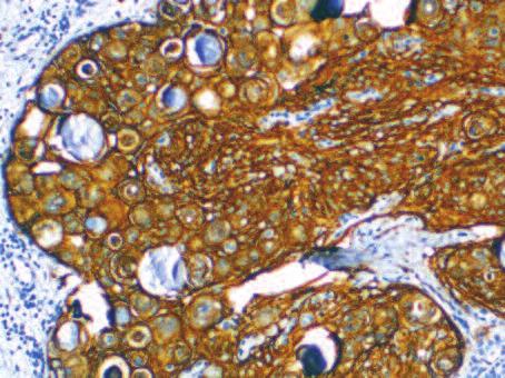 epitelde ve tümör dokusunda kuvvetli immünpozitivite, meningotelyal hücrelerde yoğun sitoplazmik immün boyanma (40 X).
