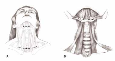 BÖLÜM 13a Subglottik Darlıklarda Cerrahi Tedavi 227 Şekil 3: A: Suprahiyoid serbestleştirme için submandibüler katlantı üzerinde 4-5 cm ikinci bir insizyon yapılır; B: Diseksiyon hiyoid kemik üzerine