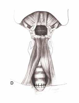 228 Şekil 4: Suprahiyoid serbestleştirmenin son ayağında ise epiglottik alan kesik çizgilerle gösterilen bölgede diseke edilerek rahatlatılır.