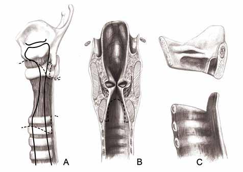 BÖLÜM 13a Subglottik Darlıklarda Cerrahi Tedavi 233 edilen posterior fibrotik mukozanın üst ucu aritenoid kıkırdakların inferior sınırında bırakılır (Şekil 6A-B).