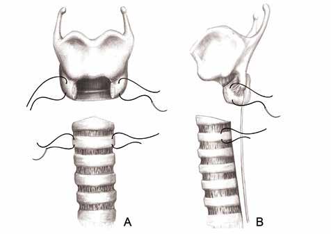 234 Şekil 7: Krikoid kıkırdağın eksizyon sonrası kalan lateral kollarından ve distal trakeada anastomozun yapılacağı halkanın distalindeki kıkırdak halkanın her iki lateralde etrafından geçen askı