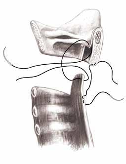 BÖLÜM 13a Subglottik Darlıklarda Cerrahi Tedavi 235 Şekil 8: Posterior mukoza flebi kullanılan anastomozlarda flebin, distal trakeanın ilk kıkırdağının her iki posterior ucunu birleştiren hat